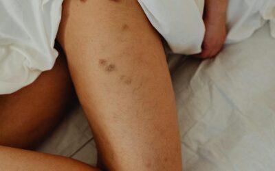 Wat helpt tegen blauwe plekken: een must-read voor elke fietser